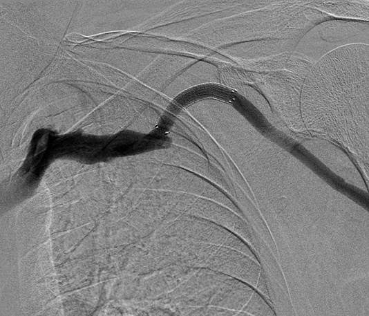 Fistulogram at 3 months