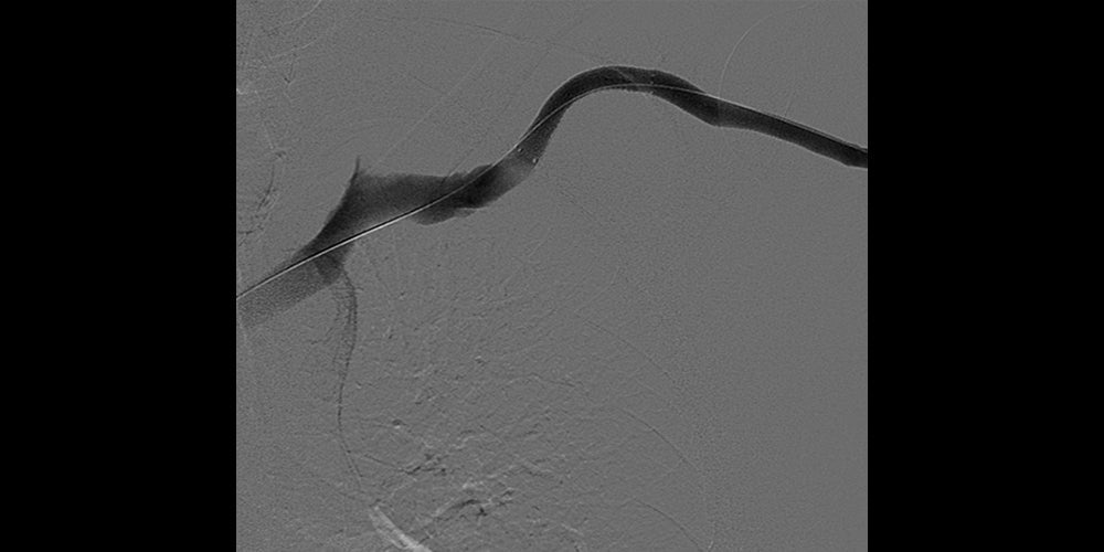 After deployment of GORE VIABAHN Endoprosthesis