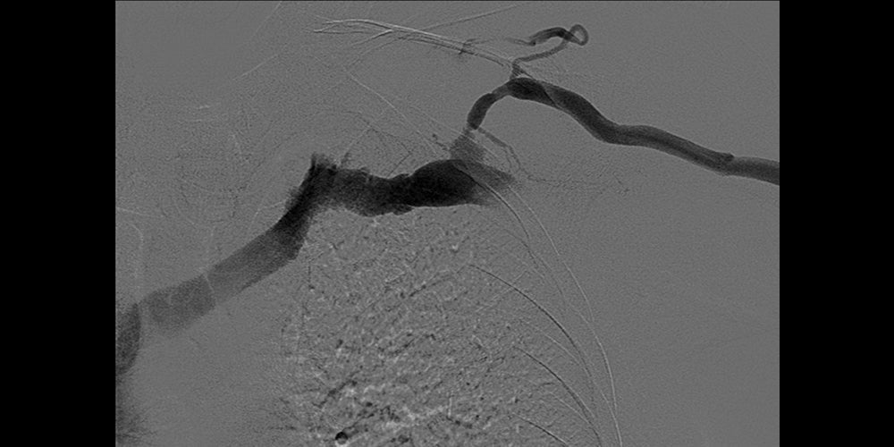 Before Cephalic arch stenosis