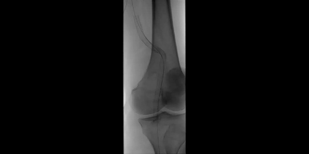 angiogram