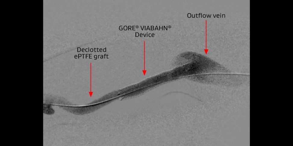 viabahn device in didactic