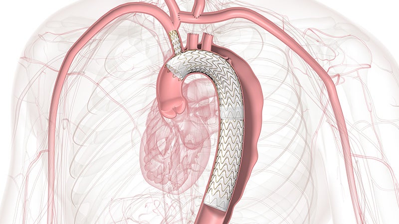 Diagram showing the anatomy of the aortic arch showing zone 0