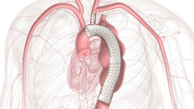 Diagram showing the anatomy of the aortic arch showing zone 1