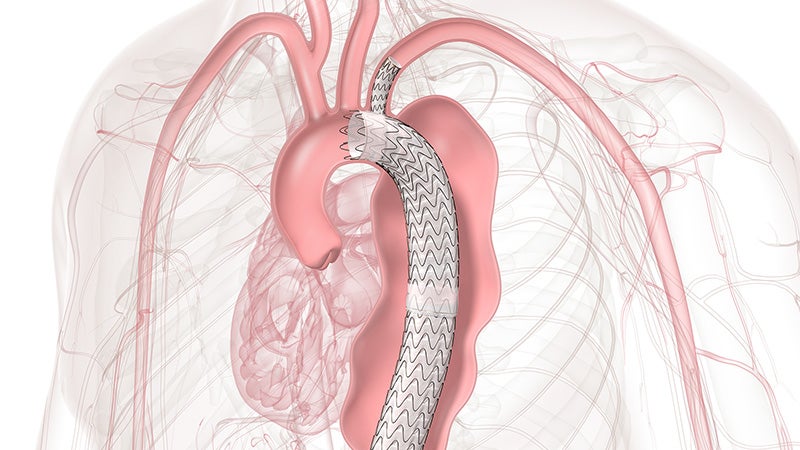 Diagram showing the anatomy of the aortic arch showing zone 2