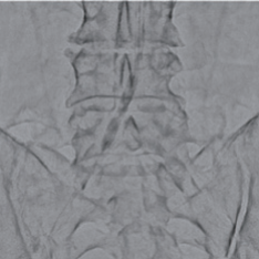 右CIA前拡張（6.0 × 40 mm）