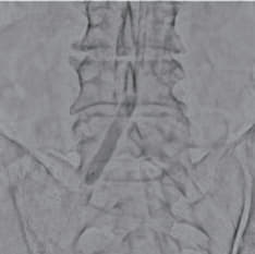 左CIA前拡張（6.0 × 40 mm）
