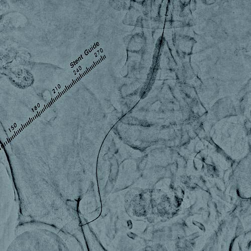 図2 VBX ステントグラフト留置