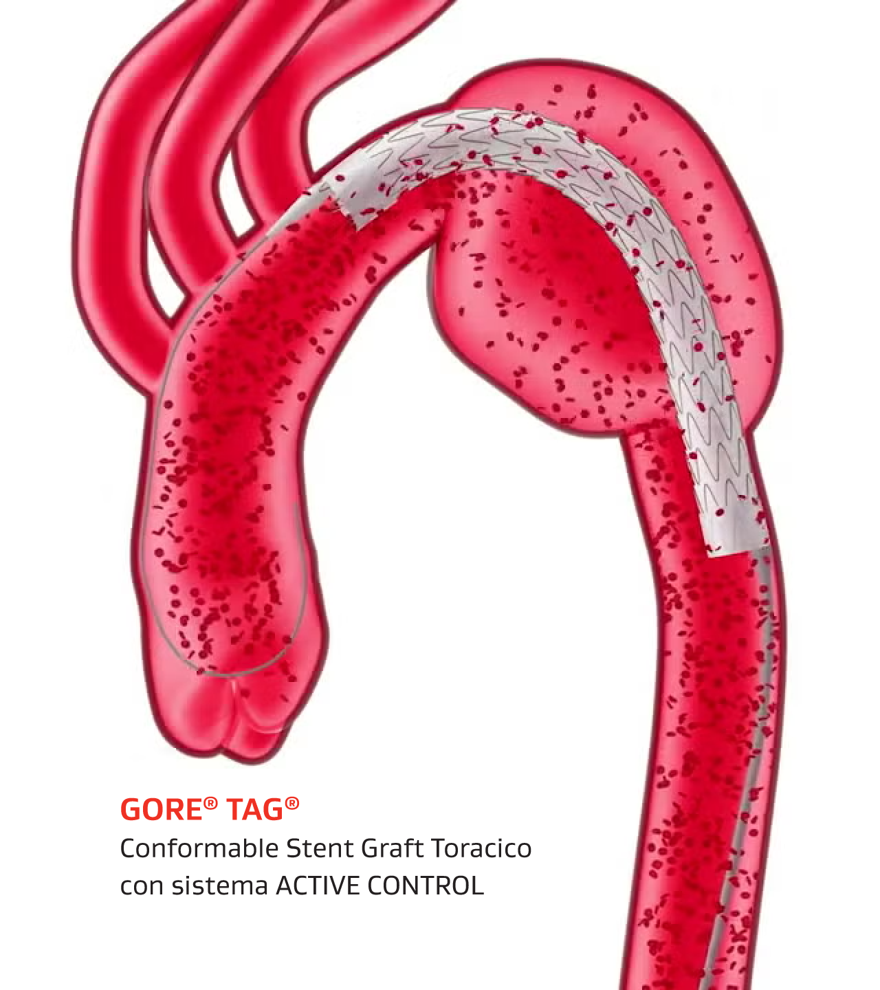 Illustrazione dello GORE TAG Conformable Stent Graft Toracico con sistema ACTIVE CONTROL