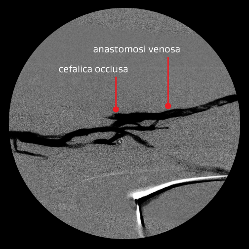 Angiogramma che mostra l'anastomosi venosa e cefalica occlusa dopo il primo intervento