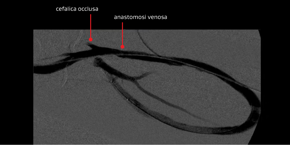 Angiogramma che mostra l'anastomosi venosa e cefalica occlusa dopo il secondo intervento