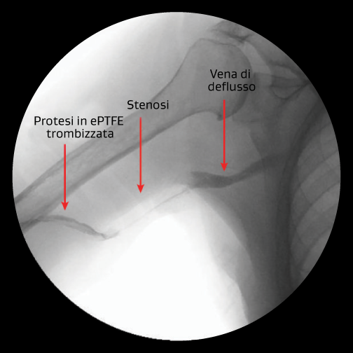 Stenosi venosa con trombosi
