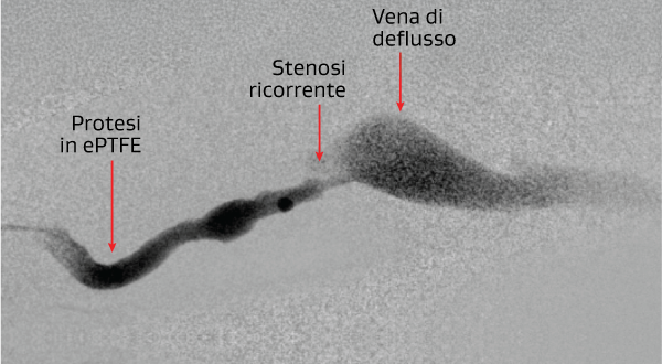 Trombectomia endovascolare