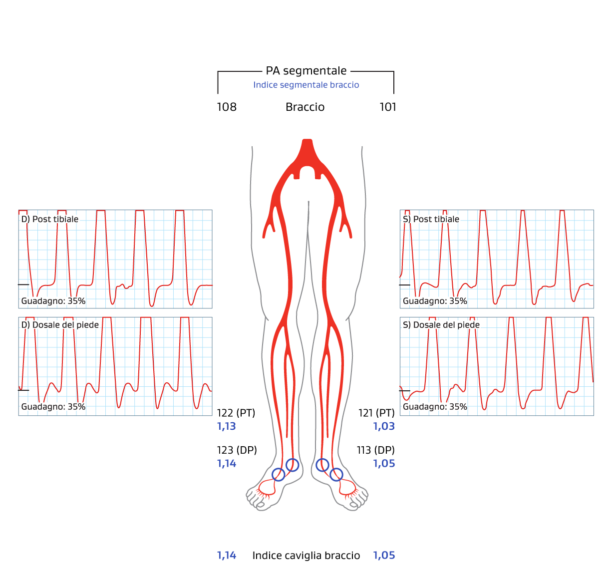 Immagine che mostra il follow-up a sei anni dell'ABI. Sinistra = 1,05, Destra = 1,14.