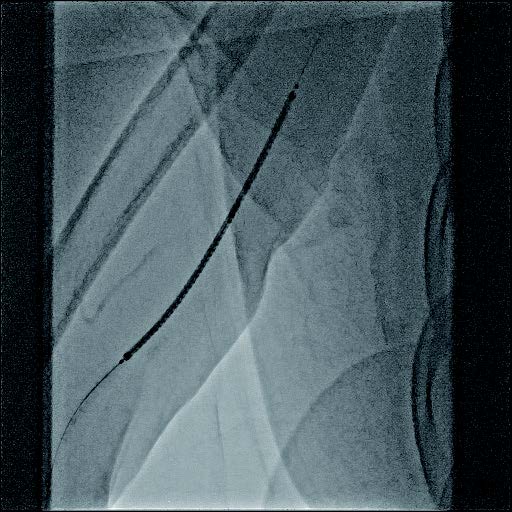 バイアバーン ® ステントグラフト挿入