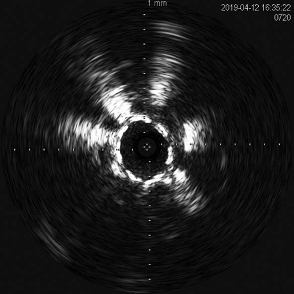 図5 径 5 mm /長 250 mmバイアバーン ® ステントグラフトの拡張は、浅大腿動脈全域にわたり良好であった。