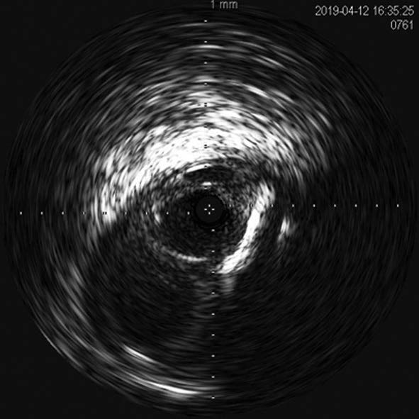 図6 浅大腿動脈入口部までは、ステントグラフトは留置していない。