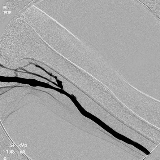 図2：バルーン拡張後の血管造影