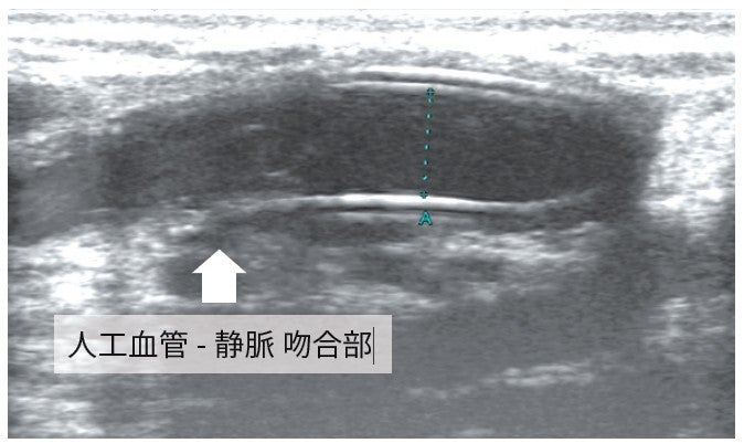 図3：VIABAHN のデバイス径を決定するためのエコー検査：デバイス留置予定部の近位端 内径 5.0 mm
