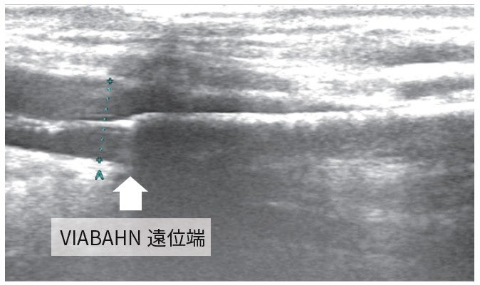 図4：エコーを用いた VIABAHN 留置前の位置決め静脈遠位端　直径 5.9 mm