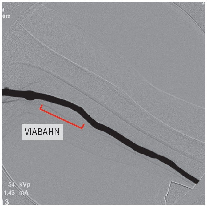 図5：VIABAHN 留置後の血管造
