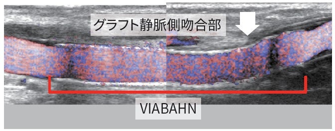 図6：VIABAHN 留置 2 週間後
