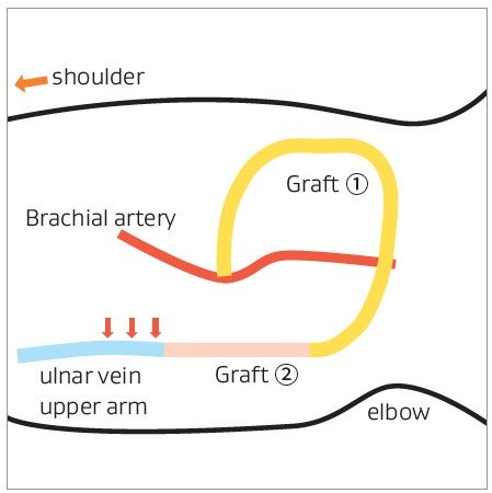 AVG のデザインと狭窄部位