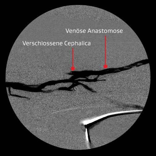 Angiogramm, das eine venöse Anastomose und eine verschlossene Cephalica nach dem ersten Eingriff zeigt