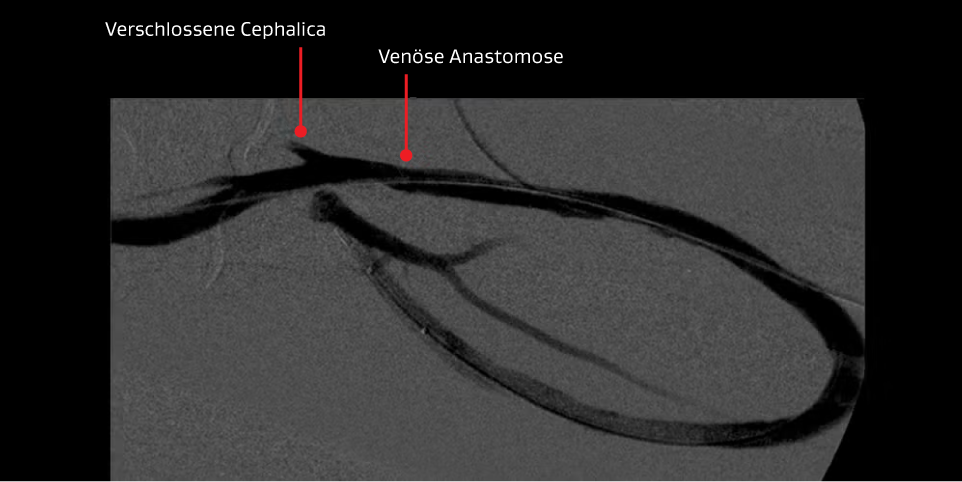 Angiogramm, das eine venöse Anastomose und eine verschlossene Cephalica nach dem zweiten Eingriff zeigt