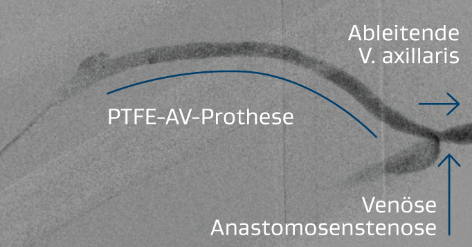Abbildung der rechten brachialaxillären AV-Prothese mit Stenose an der venösen Anastomose