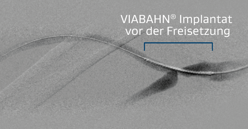 Abbildung des VIABAHN Implantats, vorgeschoben über die venöse Anastomose