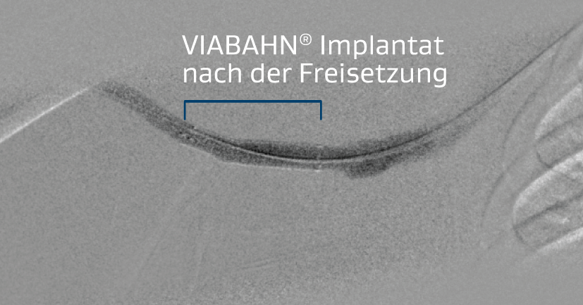 Bild des verbesserten Blutflusses und Beheben des Recoils nach Platzierung des VIABAHN Implantats