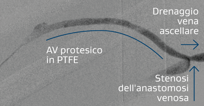 Illustrazione della protesi AV brachiale ascellare destra con stenosi a livello dell'anastomosi venosa