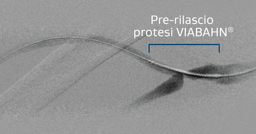 Illustrazione della protesi VIABAHN avanzata attraverso l'anastomosi venosa