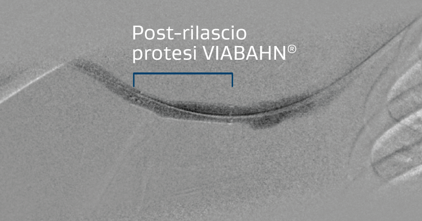 Flusso migliorato e risoluzione del recoil dopo il posizionamento della protesi VIABAHN