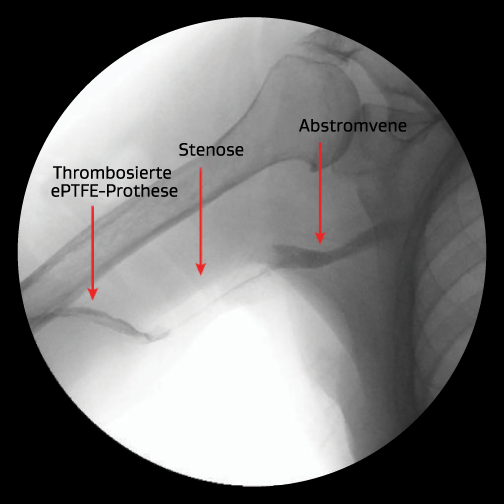 Venöse Anastomosenstenose mit Thrombose