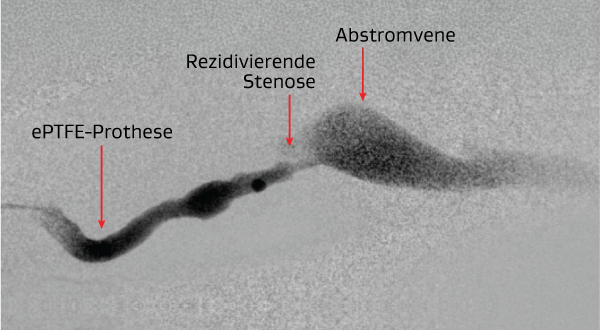 Endovaskuläre Thrombektomie