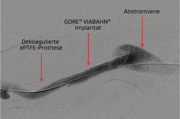 Viabahn-Implantat in der Didaktik