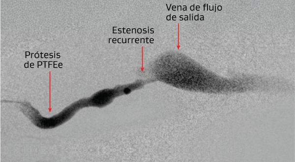 Trombectomía endovascular