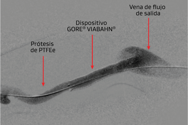 dispositivo viabahn en didáctica