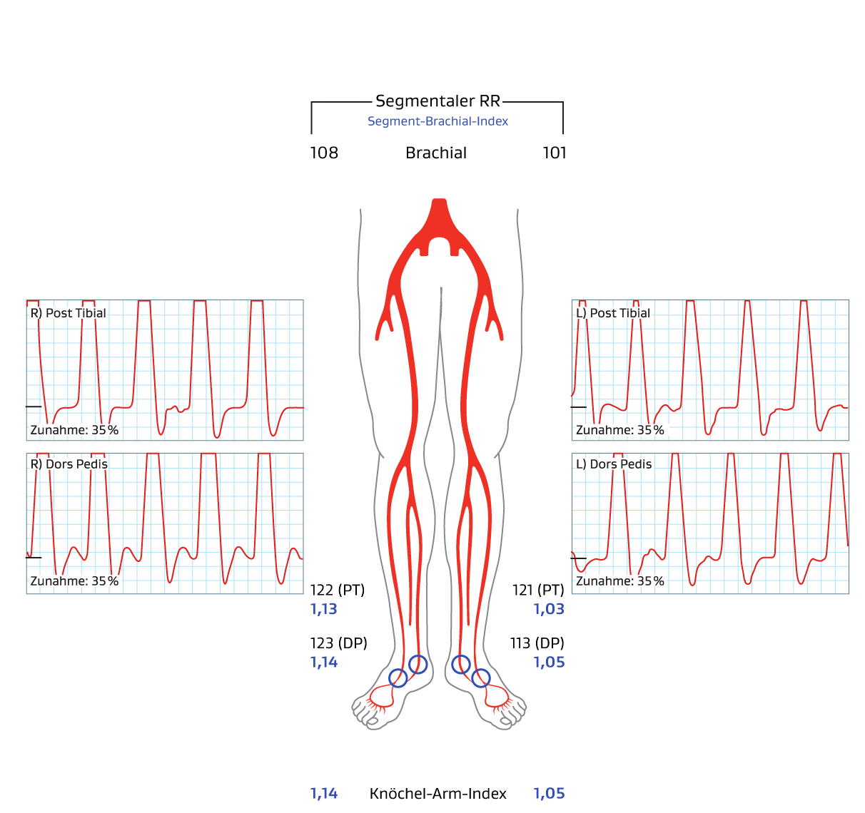 Abbildung zeigt ABI beim 6-Jahres-Follow-up. Links = 1,05, rechts = 1,14.