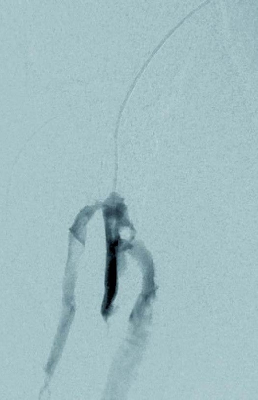 図1-2 術前 右SFA 入口