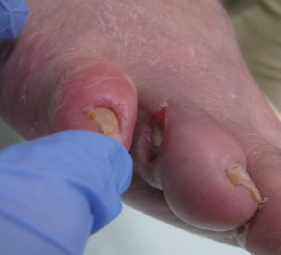 図3 右第4足趾の潰瘍で紹介。包括的高度慢性下肢 虚血（CLTI）と診断