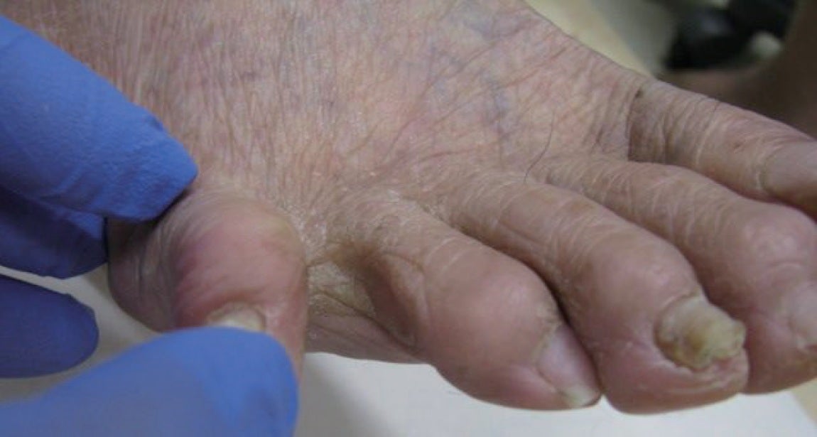 図4 術後1か月で潰瘍は乾燥し、3か月後には上皮化 し治癒した