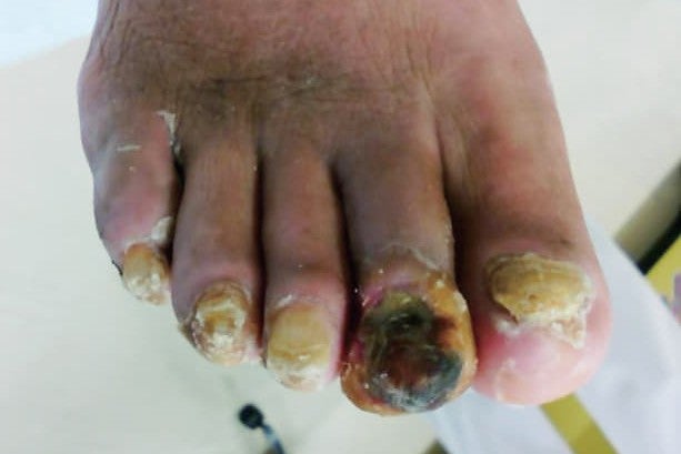 図1 右第2趾潰瘍・壊死