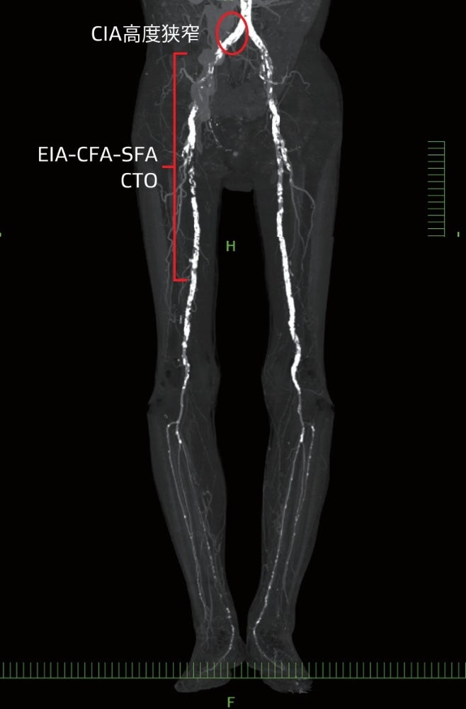 図2 高度石灰化