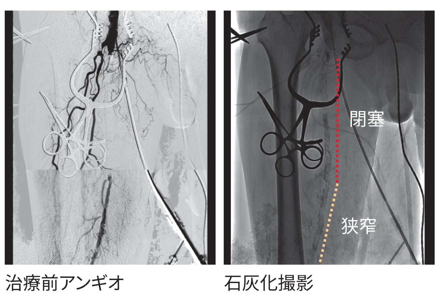 図3 治療前アンギオ・石灰化撮影