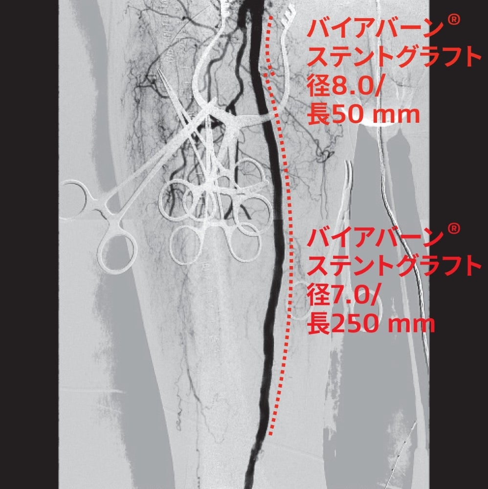 図4 バイアバーン® ステントグラフト留置部の良好な拡張