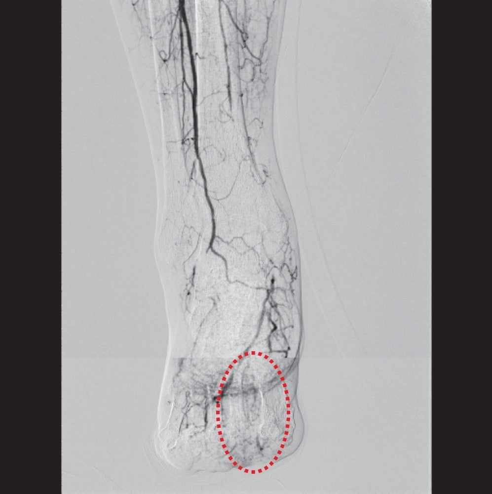 図5 患趾までの良好な血流を確認