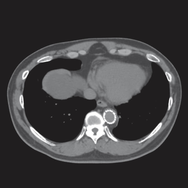 術後半年 Axial CT