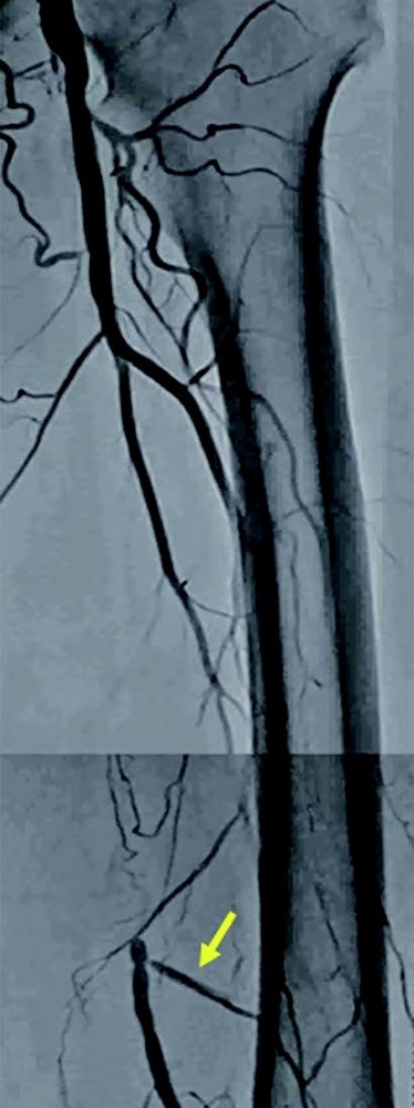 図1 術前造影画像 (Lt.SFA)